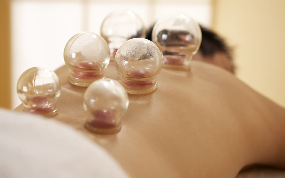 Cupping Therapy