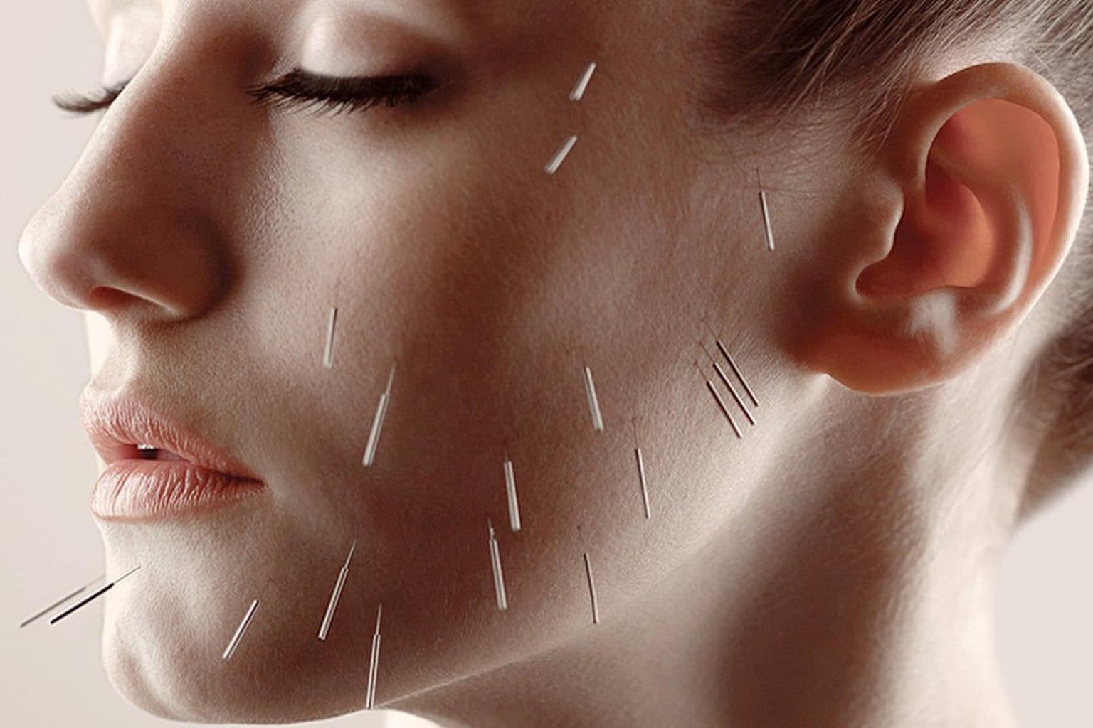 Cosmetic Acupuncture